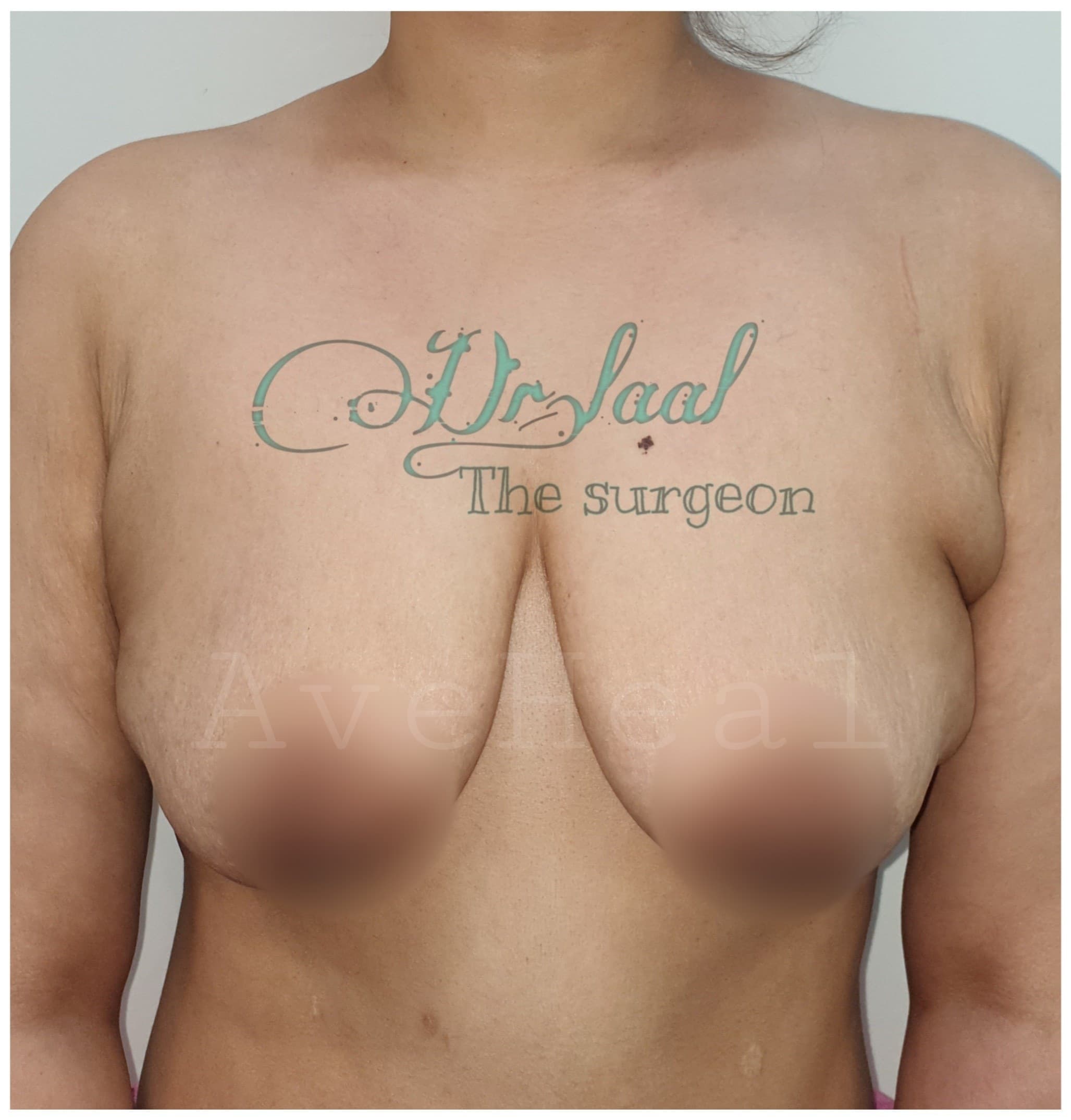 before-breast-lift-dr-homeira-laal-khoshab